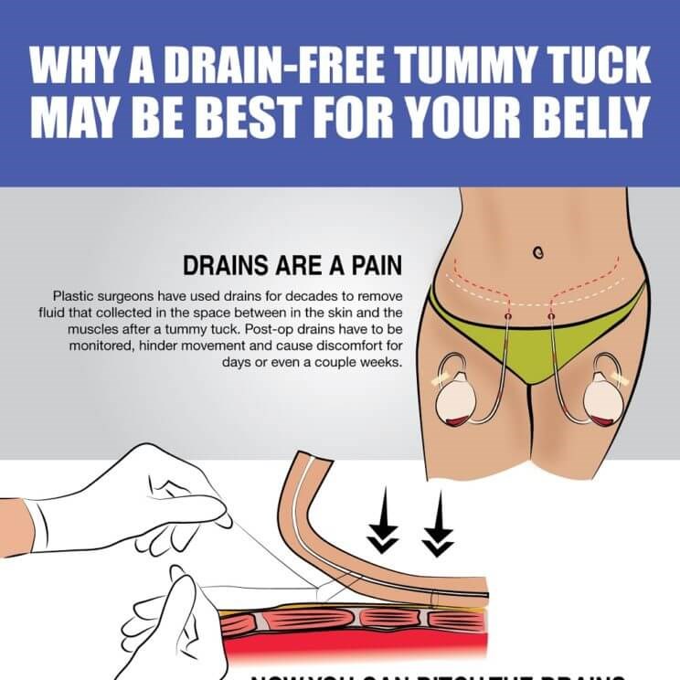 Tummy Tuck